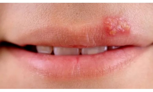 Consigli e rimedi per curare l'herpes labiale e favorirne la guarigione