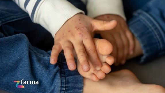 Malattia Mani Bocca Piedi: cos’è e come riconoscerla