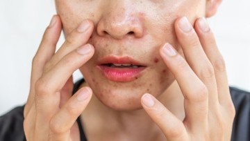Pelle grassa: cos’è e come trattarla