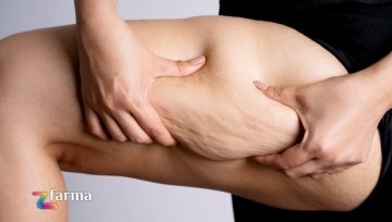 Come trattare la cellulite