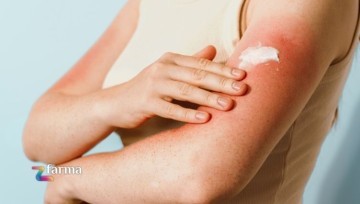 Le migliori creme per le scottature Le migliori creme per le scottature